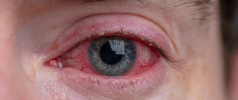 A szem trombózisa a látás helyreállítása Etiológia és patogenezis