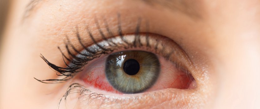 A retina vénájának elzáródása