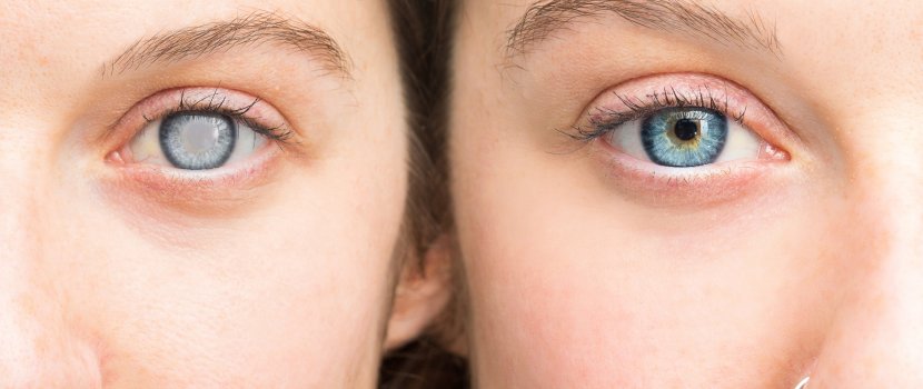 hályog a szemen tünetek javítsa a látást száz százalékkal