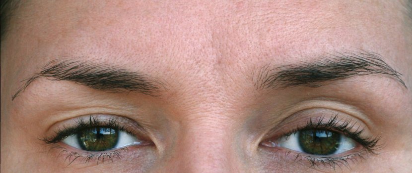 A pajzsmirigybetegségek szemészeti vonatkozásai