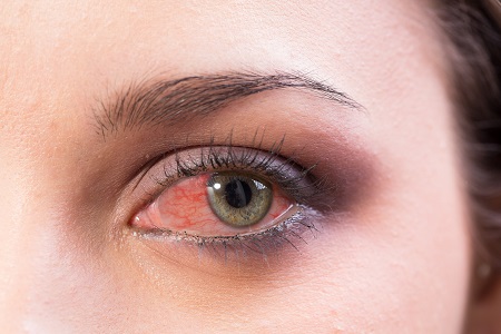 A vörös, gyulladt szem nem csak kötőhártya gyulladás tünete lehet.